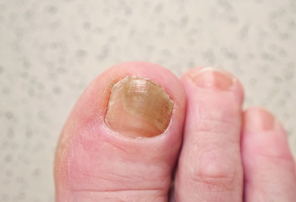 tratamiento hongos uñas podólogo Lepe