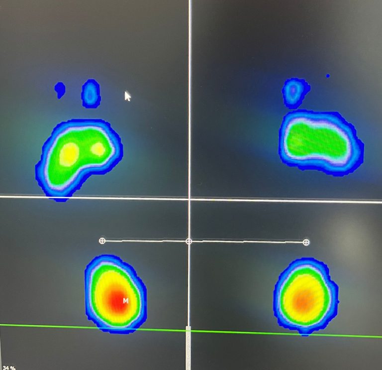 podólogo realizando estudio de pisada en Lepe